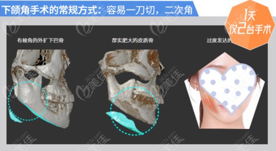 姜民范做下颌角削骨怎么样