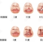 武漢唇腭裂修復(fù)好的醫(yī)生名單