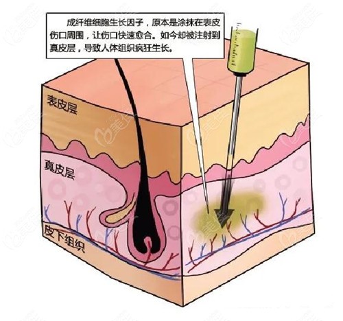 臉上打多少生長因子會(huì)引起瘋長