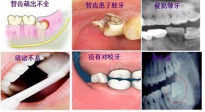 在郑州拔智齿大概多少钱一颗