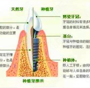 楚雄種植牙多少錢一顆