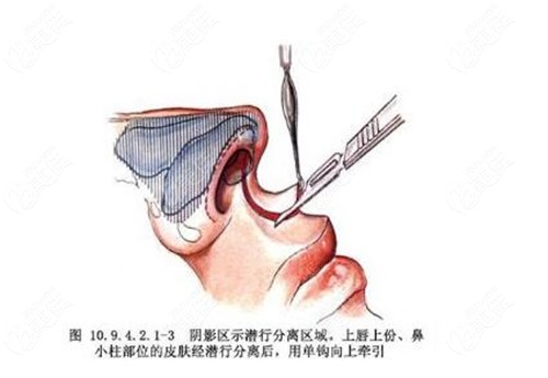 哈爾濱唇裂修復(fù)醫(yī)院排名