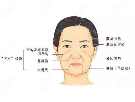 听说面部口角囊袋除了做吸脂手术去除外