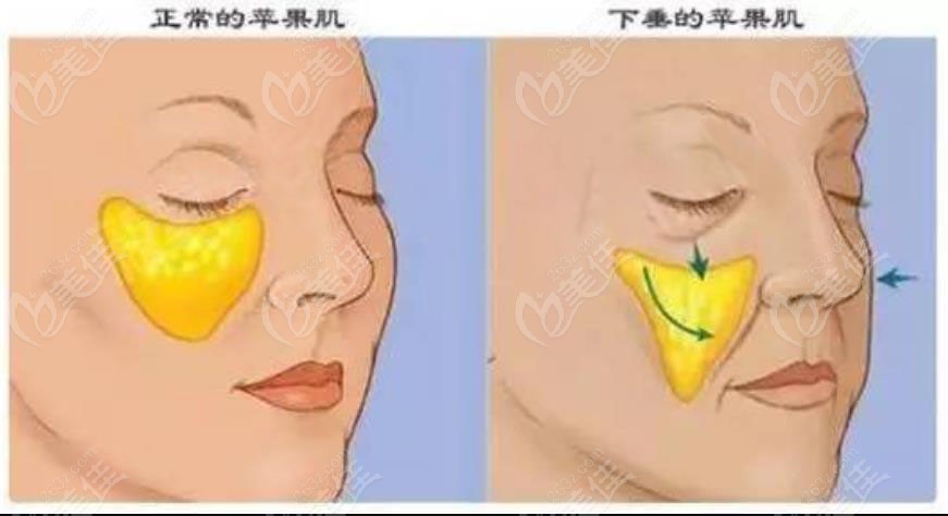 蘋果肌復(fù)位隱形小切口拉皮多少錢