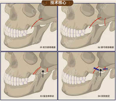 上海顴骨內(nèi)推哪個(gè)醫(yī)生好呢