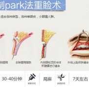 銀川麗都割雙眼皮怎么樣呢