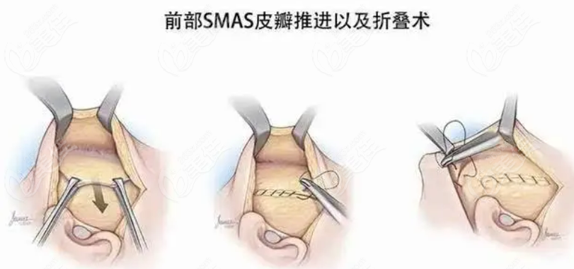 國內(nèi)smas筋膜提升術(shù)哪個醫(yī)生厲害