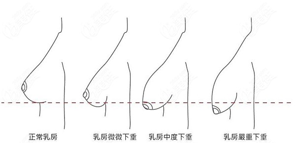 郑州做缩胸手术好的医院有五家