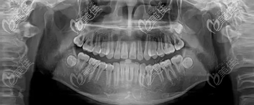看牙要拍的口腔全景片到底有什么用
