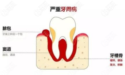 牙齦上長膿包怎么回事