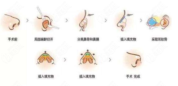 做完鼻综合三个月可以重新修复吗