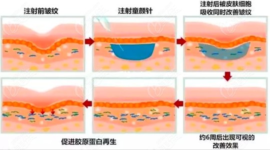 武漢哪個(gè)醫(yī)院能打童顏針