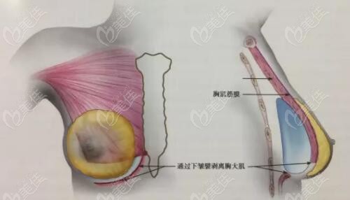 已经做了假体隆胸