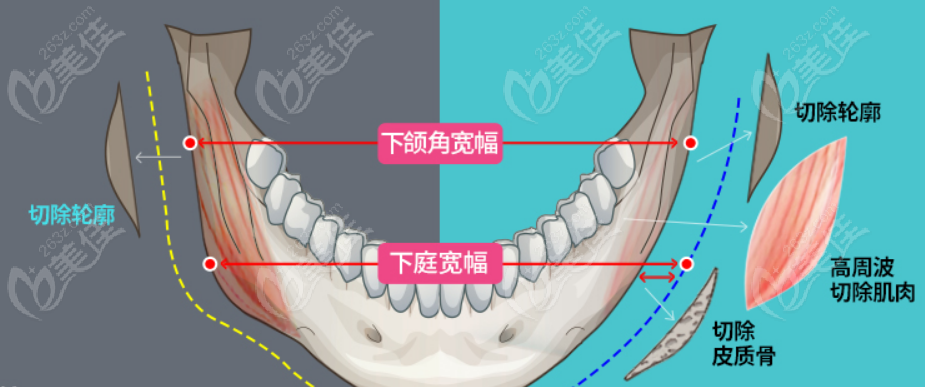 下頜角整形手術(shù)過(guò)程揭秘