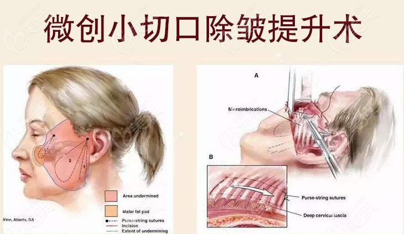 郑州哪个机构做微创拉皮手术好