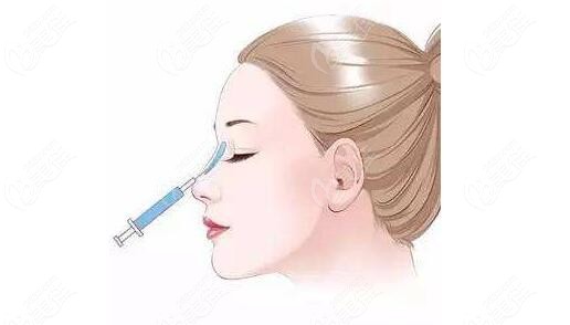 原来平顶山做鼻子需要多少钱是由你做假体还是注射玻尿酸隆鼻决定的