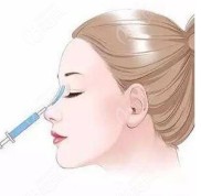 原來(lái)平頂山做鼻子需要多少錢是由你做假體還是注射玻尿酸隆鼻決定