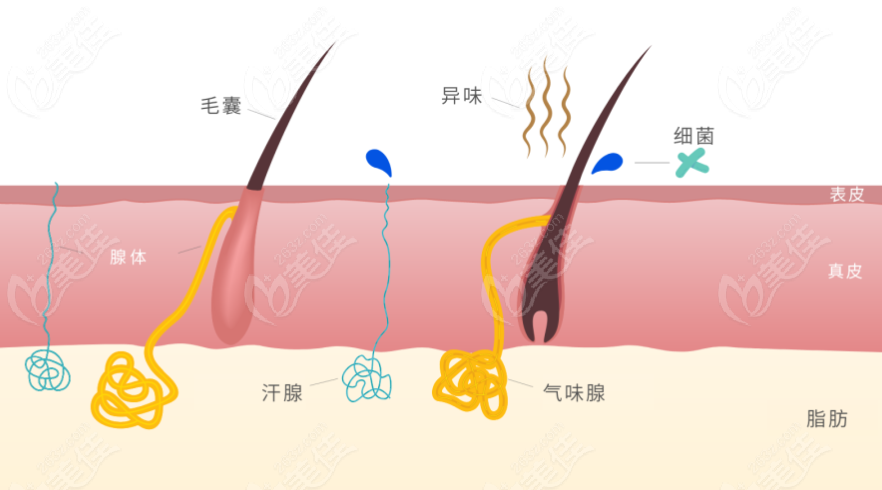 成都哪里能做清新微波腋臭手术