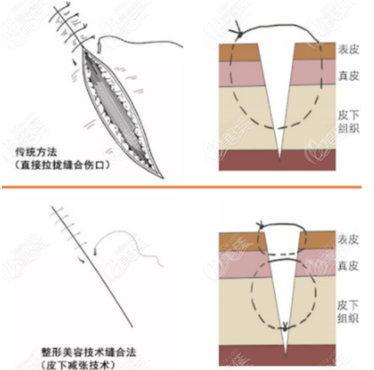 白永輝修復(fù)雙眼皮怎么樣