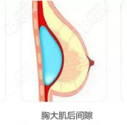 重慶時光那個IN-BRA動感假體豐胸是個什么技術