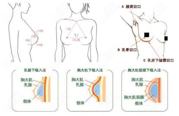 假体隆胸下皱襞位置太低怎么补救