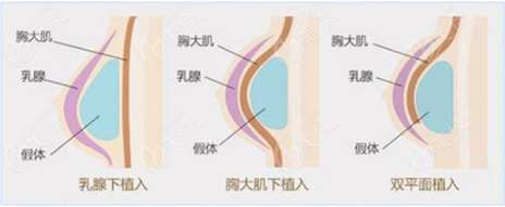 福州丰胸去哪家医院好呀