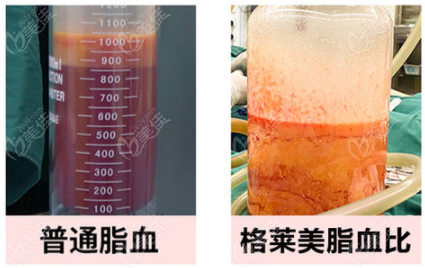 福州瘦小腿吸脂多少钱呢