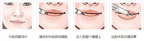 厦门玻尿酸丰唇哪个医生好呢