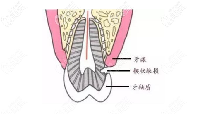 楔状缺损千万不要盲目补牙