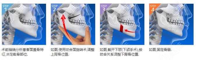 做地包天矯正找韓國(guó)必嫵跟id哪個(gè)好