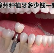 漳州種植牙多少錢一顆