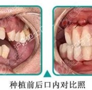 在南通做allon4全口即刻負(fù)重種植牙的38歲帥鍋效果圖和費(fèi)