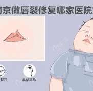 南京做唇裂修復哪家醫(yī)院好