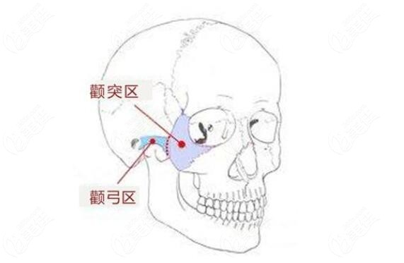 顴骨突出做一針降顴骨和顴骨內(nèi)推哪個(gè)好