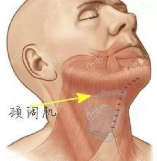 双平面复合拉皮多少钱