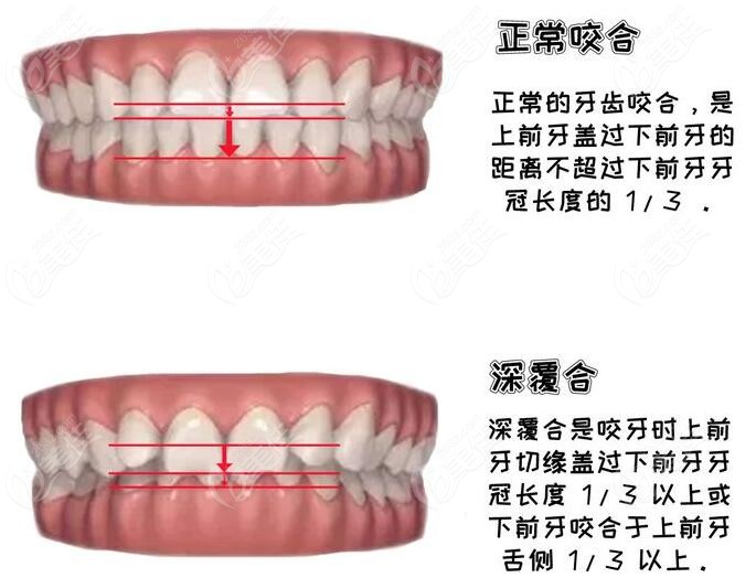 矯正收完牙縫還是深覆合怎么辦