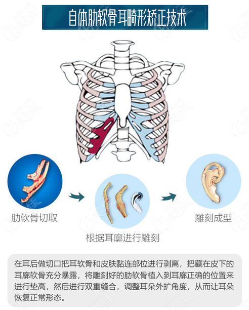 淺談耳畸形再造手術(shù)醫(yī)保能否報銷