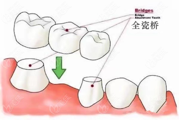 全瓷牙是一組好還是一個(gè)個(gè)做好