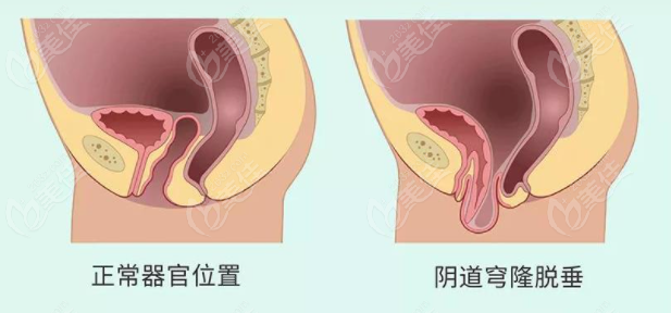 國(guó)內(nèi)做3d生物束帶緊縮術(shù)多少錢