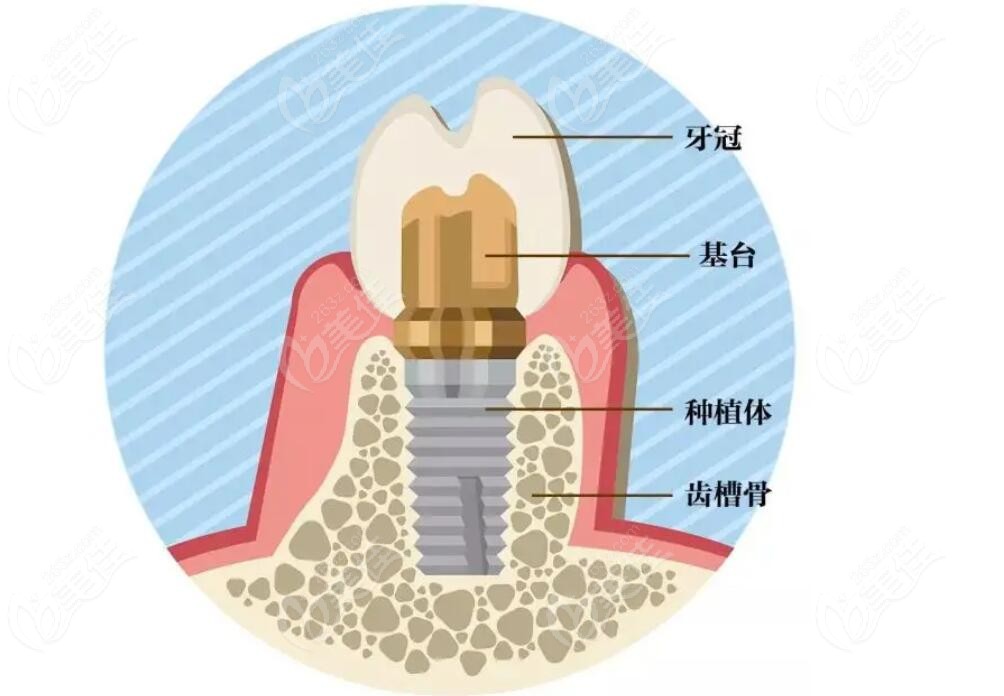 德国瑞西欧ht种植牙性价比怎么样