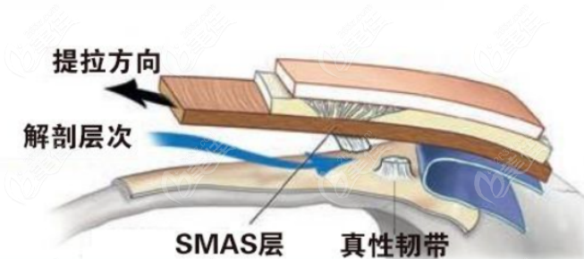 双平面复合拉皮多少钱