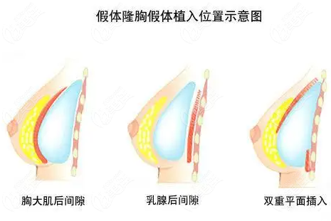 济南艺星做假体隆胸怎么样