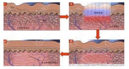 從射頻溶脂瘦臉術(shù)過(guò)程