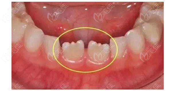 換牙期的孩子門牙黃、大還有鋸齒都屬于正?，F(xiàn)象