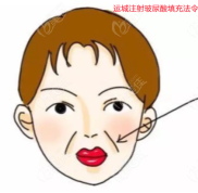 運城玻尿酸填充法令紋哪家好