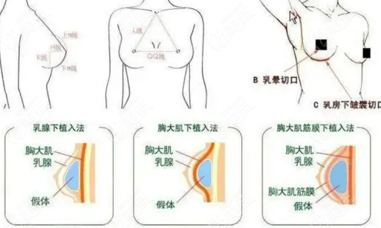 國(guó)內(nèi)沸騰溝豐胸術(shù)醫(yī)生排行榜