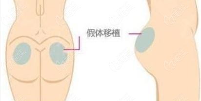 臀假體取出率高的原因和術(shù)后一邊屁股超級疼等副作用有關(guān)嗎