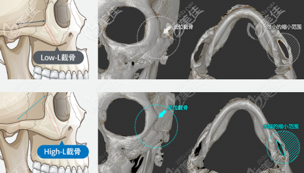 韓國id醫(yī)院High-L顴骨縮小術(shù)跟普通L型截骨有什么區(qū)別
