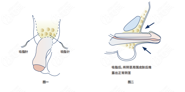 怎樣延長陰莖長度