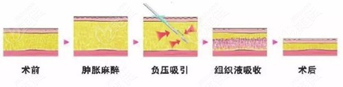 贛州欣范做吸脂手術(shù)多少錢啊